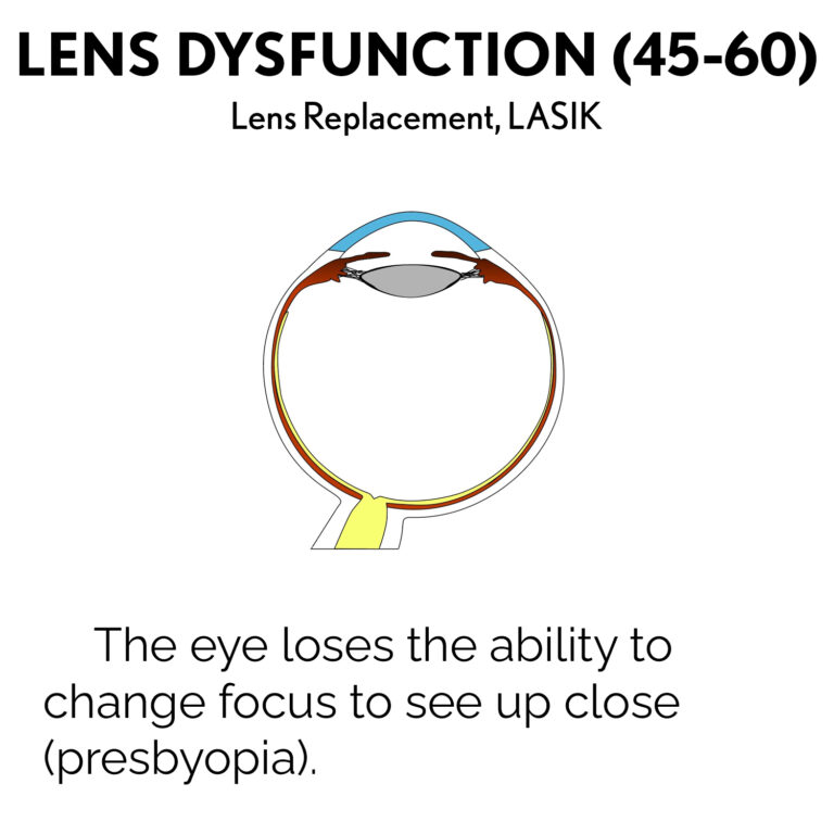 Lens Dysfunction